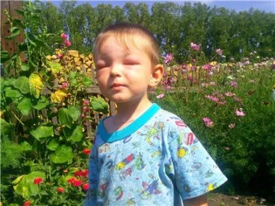 umflarea alergică a feței de ce există, simptome și tratament
