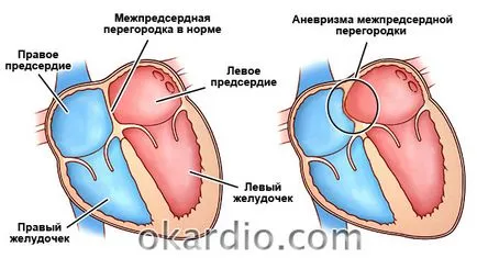 PAM anevrism (septal atrial) la adulți și copii