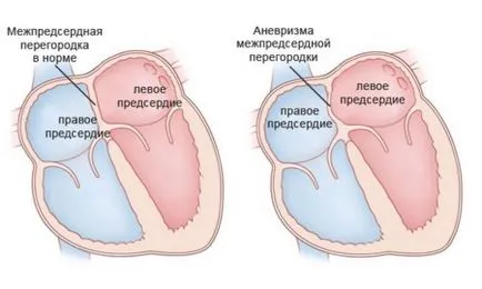 Anevrism a atriale MPP anevrism septal ce este