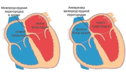 anevrism PAM