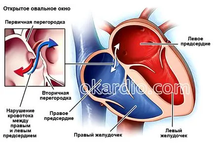 PAM anevrism (septal atrial) la adulți și copii