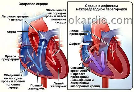 PAM anevrism (septal atrial) la adulți și copii