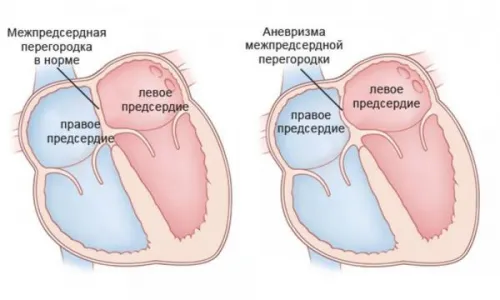 PAM anevrism la adulți și copii (anevrism partea bombarea) PAM anevrism la adulți și copii