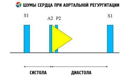Cauzele aortic regurgitare, simptome, diagnostic, tratament, competente pentru sanatate pe ilive