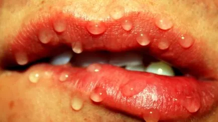 durere în alb (ulcer) la buza laterală interioară (ulcere) durere în alb (ulcer) la buza laterală interioară