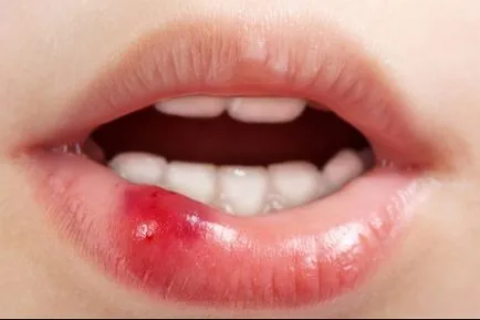 durere în alb (ulcer) la buza laterală interioară (inflamat) durere în alb (ulcer) la buza laterală interioară