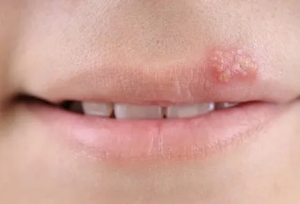 durere în alb (ulcer) la buza laterală interioară (inflamat) durere în alb (ulcer) la buza laterală interioară