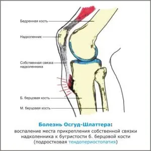 Osgood-shlyattera simptome, tratament și consecințe