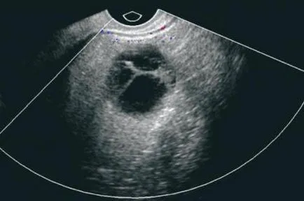 Hurts (tragerea) cauzele ovariene, simptome, diagnostic, tratament