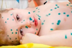 Spălarea Zelenka de pe piele după varicelă sfaturi utile pentru a vă ajuta să „broasca“ pentru a porni în