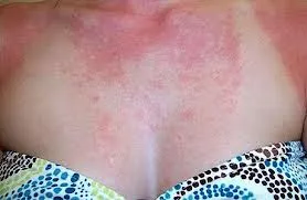 Cum de a elimina alergie Cum de a elimina alergie