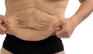 Cum de a elimina pielea lasata pe abdomen Cum de a elimina pielea lasata pe abdomen