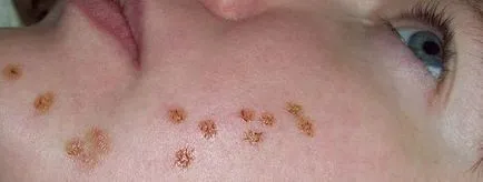 Comedon cauteriza pe fata (poate cauteriza peroxid de hidrogen) Cauteriza un cos pe fata