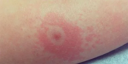 Ce să fac dacă sunt lăsate denivelare sau umflare la locul mușcăturii de căpușă, un adevăr (do) Ce să fac dacă umflatura la stânga sau umflare la locul mușcăturii de căpușă, propriul său adevăr