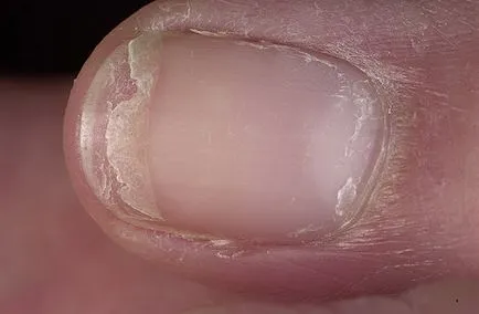 Ce se poate face la domiciliu, dacă unghiile exfolia (unghii exfoliate) Ce se poate face la domiciliu, dacă unghiile exfoliate