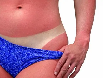 Ce se întâmplă dacă ars în solar nu intra in panica - toate fixabil - pulsul frumuseții feminine și modă