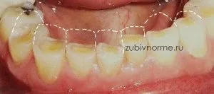 Ce este cauzele bruxism, simptome, tratament, bruxism paza gurii cu (motiv) Ce este cauzele bruxism, simptome, tratament, paza bruxism gura atunci când