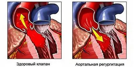 Ce este aortică gradul 1 regurgitare