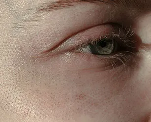 Ce este cu laser fototermolizei fracționată și modul în care funcționează (a) Ce este fracționată fototermolizei cu laser este și cum funcționează