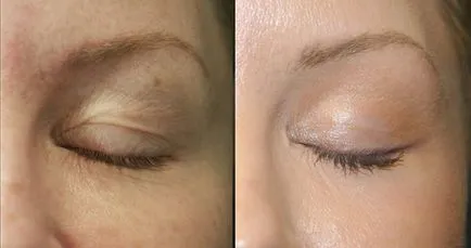 Ce este fracționată fototermolizei cu laser este și cum funcționează (fracționară fotografie cu laser fototermolizei imediat după procedurile de fotografii înainte și după vârsta persoanei) Ce este fracționată fototermolizei cu laser este și cum funcționează