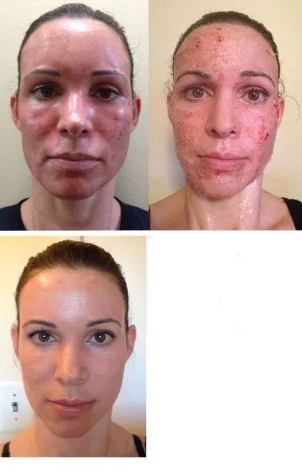 Ce este cu laser fototermolizei fracționată și modul în care funcționează (după acnee) Ce este fracționată fototermolizei cu laser este și cum funcționează