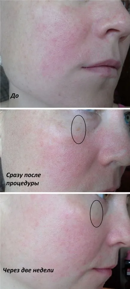 Ce este cu laser fototermolizei fracționată și modul în care funcționează (fototermolizei) Ce este fracționată fototermolizei cu laser este și cum funcționează