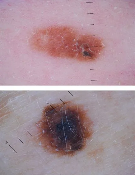 pigment nev displazic când și cum să eliminați