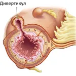diverticul esofagian, simptome și tratament