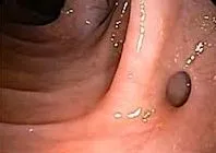 diverticuli a esofagului - cauze, simptome, diagnostic și tratament
