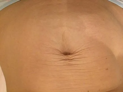 piele laxă stomac ce să facă, cum să curățați acasă