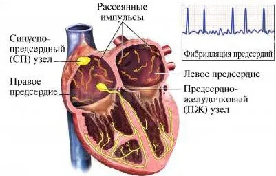 Fibrilația atrială - cauze, simptome și tratament