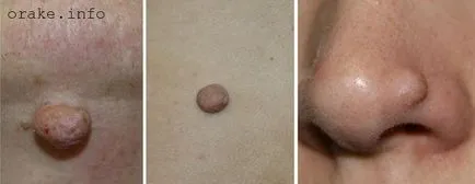 Fibrom fotografie pielii care face, prognosticul (ce să facă) piele fibrom fotografie care fac, prognostic