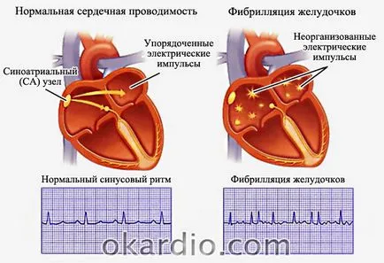 Simptomele fibrilatie atriala, tratamentul si forma prognostic