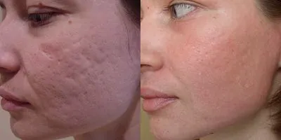 Fraxel (Fraxel) - fototermolizei fracționată, cu laser intinerire faciala - ce este, prețurile,