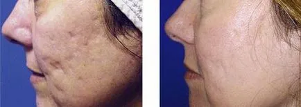 Fraxel (Fraxel) - fototermolizei fracționată, cu laser intinerire faciala - ce este, prețurile,
