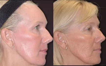 Fraxel (Fraxel) - fototermolizei fracționată, cu laser intinerire faciala - ce este, prețurile,