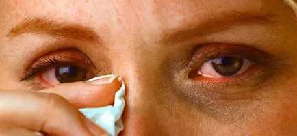ochi Herpes (ophthalmoherpes) - simptome, tratament, foto (simptome) ochi Herpes (ophthalmoherpes) - simptome, tratament, fotografii