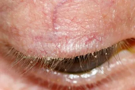 Eye tratament acarianul la om, simptome, foto (simptome) Eye tratament acarianul la oameni, simptome, fotografii