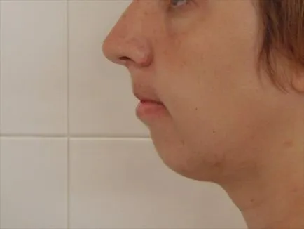 Overbite cum să se stabilească, înainte și după fotografii de tratament