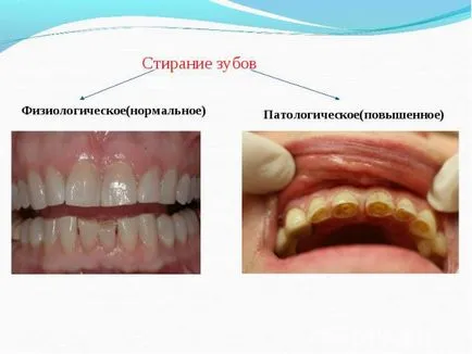 Overbite cum să se stabilească, înainte și după fotografii de tratament