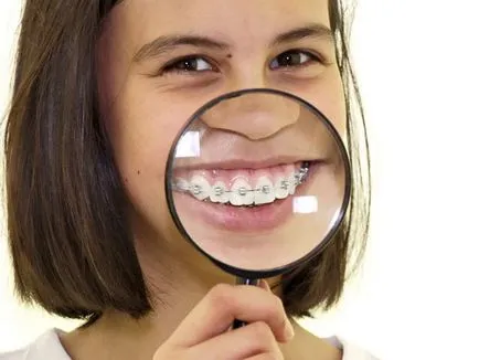 Overbite cum să se stabilească, înainte și după fotografii de tratament