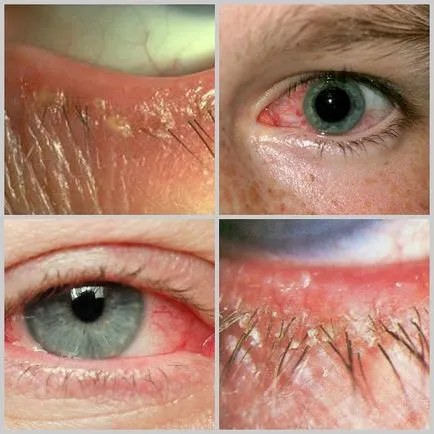 Eye tratament acarianul la om, simptome, foto (simptome) Eye tratament acarianul la oameni, simptome, fotografii