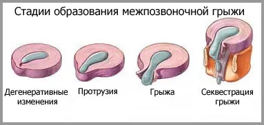 hernia de disc, informații despre simptome, diagnostic si tratament