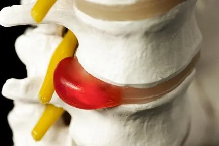 Herniate simptomele coloanei cervicale si tratamente, gimnastica