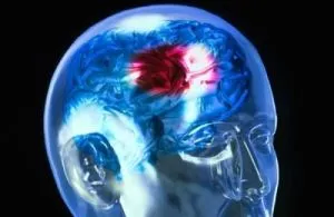 consecințe ale infarctului cerebral, tratament și reabilitare