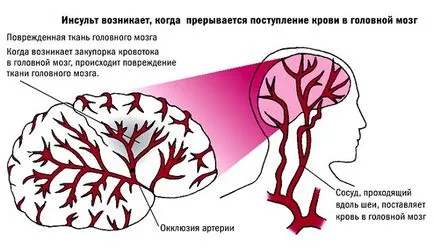 consecințe ale infarctului cerebral, tratament și reabilitare