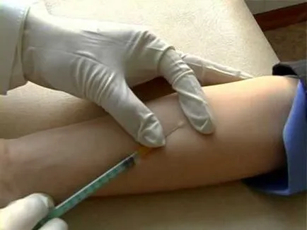 Simptomele alergice infecțioase și descriere