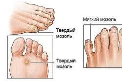 Cum de a vindeca rapid un blister pe călcâi