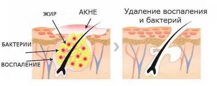Cum de a obține rapid scăpa de acnee la opinia medicului acasă (acnee) Cum de a obține rapid scăpa de acnee, la opinia medicului acasă