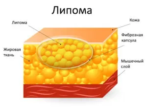 Cum de a scăpa de lampă cu ulei, fără o intervenție chirurgicală